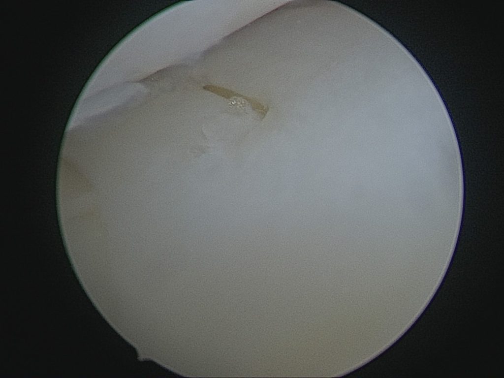 Sutt meniscus2016-04-20_092345_IMG0002