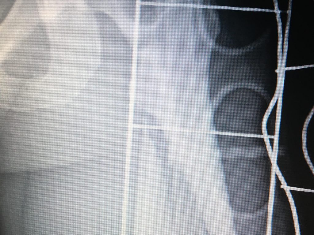 femur frx1