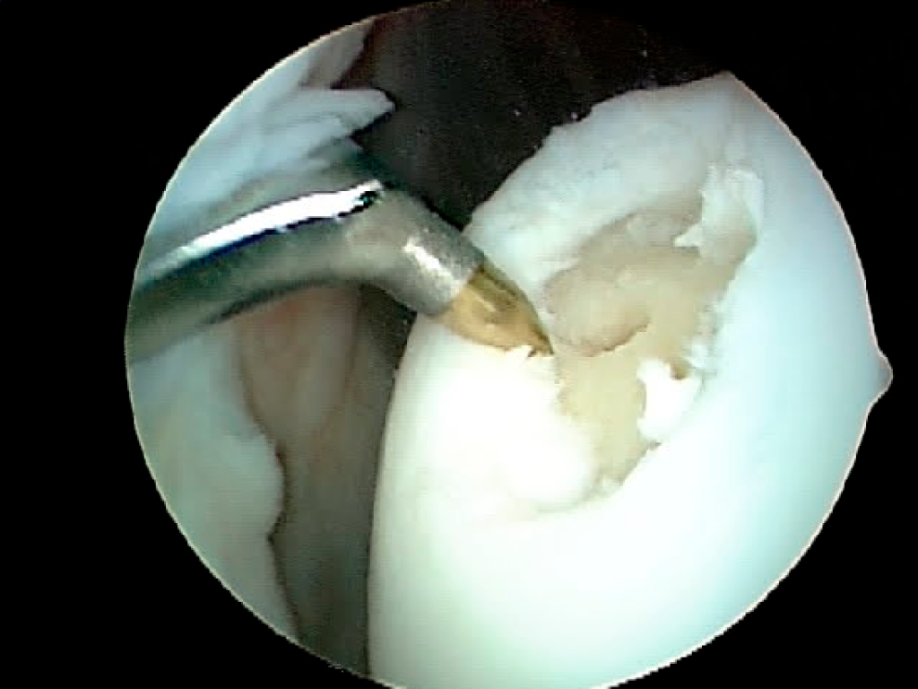 hondroplastiki-1
