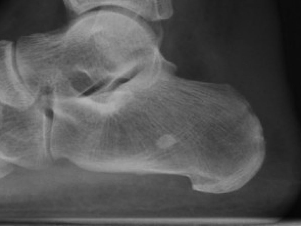 post-op-haglund-e1466144761467-300x221